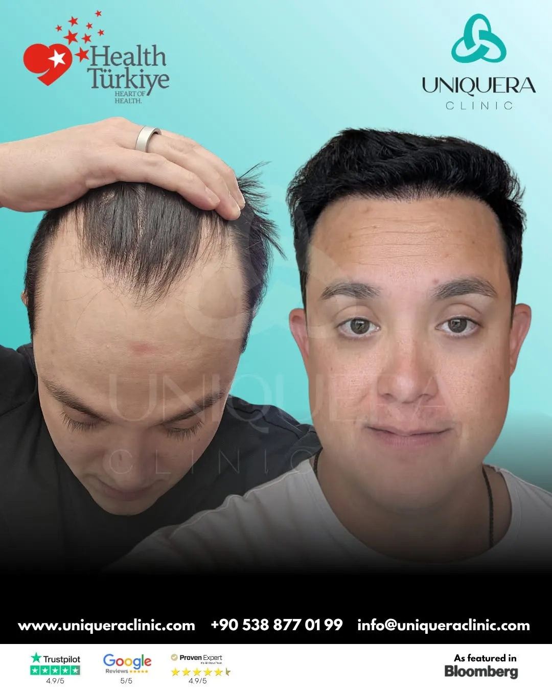 Is Hair Transplant Worth It? Pros and Cons Unveiled