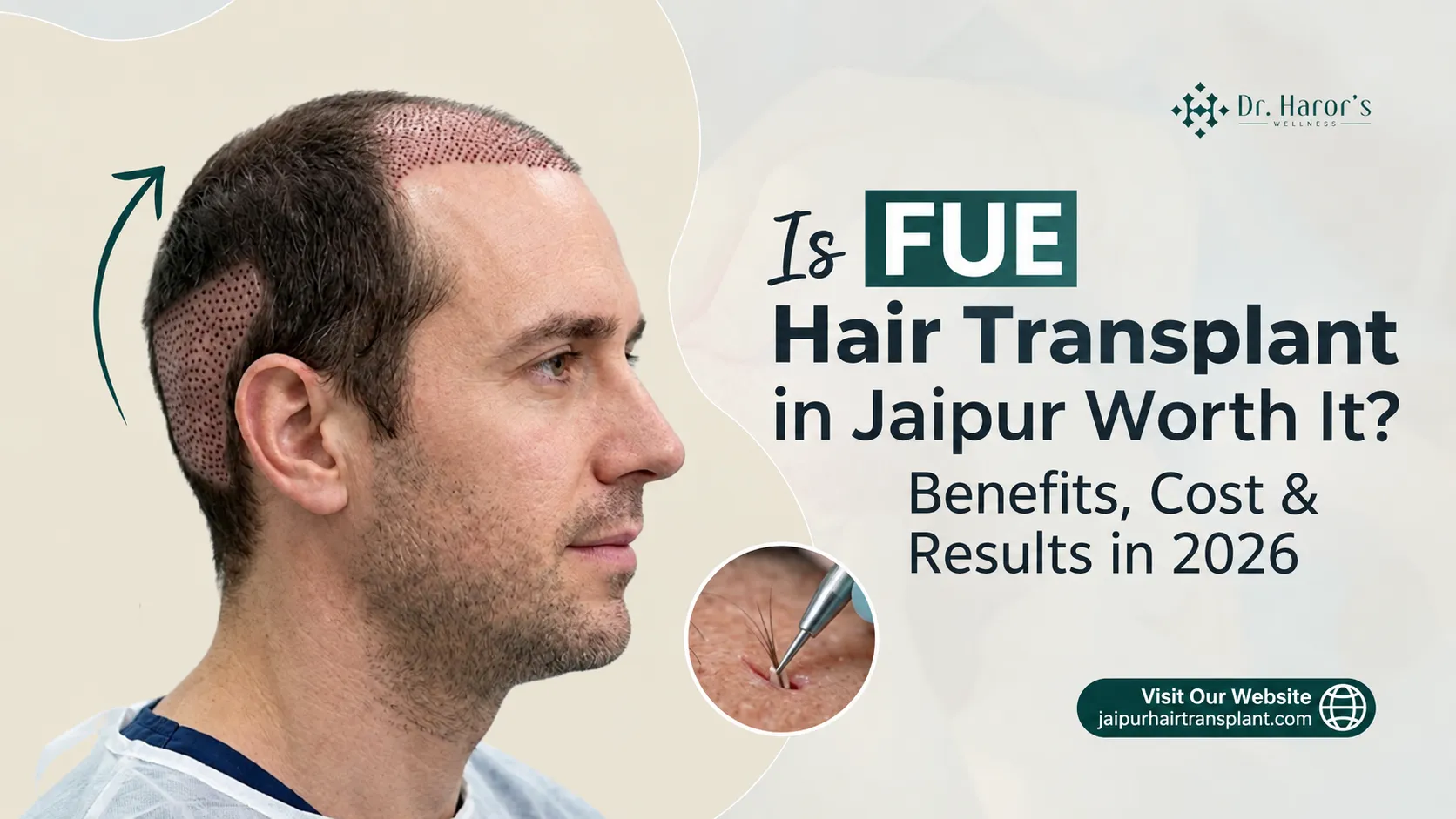 Is FUE Hair Transplant in Jaipur Worth It? Benefits, Cost & Results in 2026