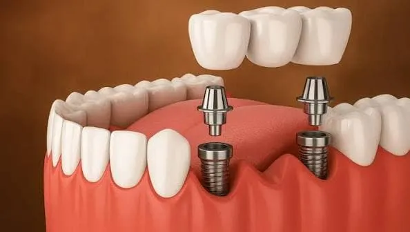 What Are the Warning Signs of a Failing Dental Implant?
