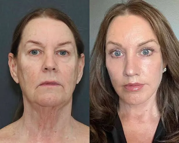 How Does a Facelift Affect the Jawline?