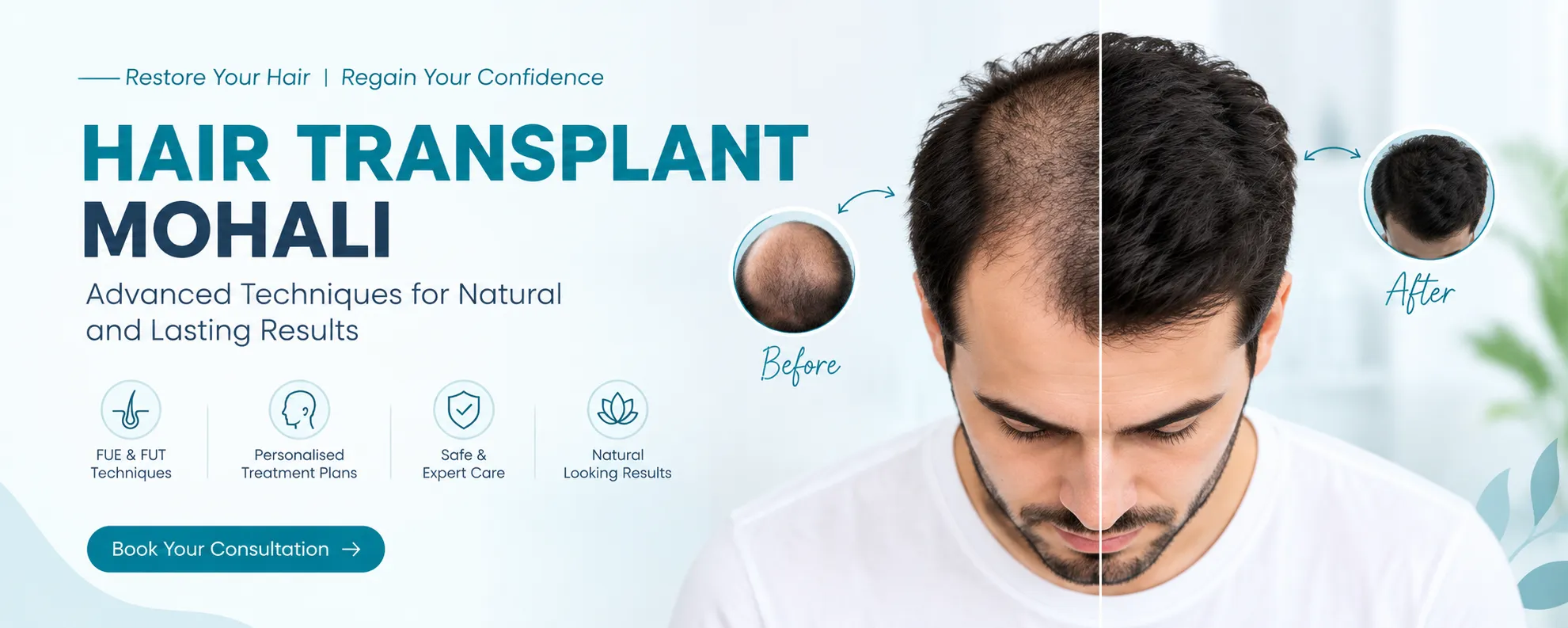 Hair Transplant Mohali: A Complete Guide to Hair Restoration, Techniques and Recovery