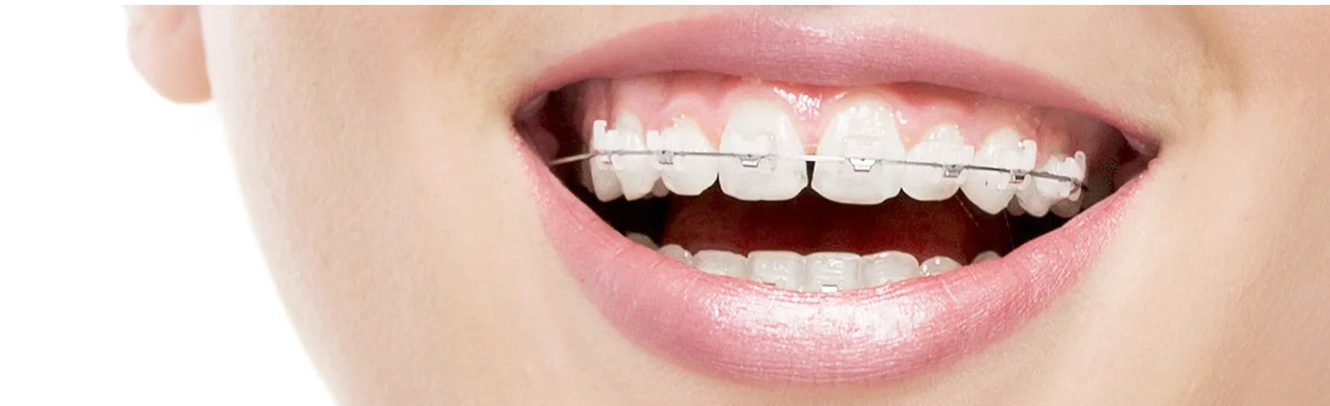 10 Signs It's Time to Visit an Orthodontist Instead of Waiting