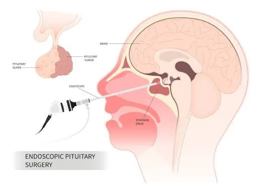 What Are the Benefits of Endoscopic Pituitary Surgery in India?
