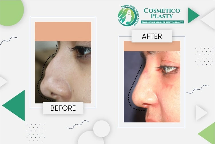 Educational facts about rhinoplasty that you should know