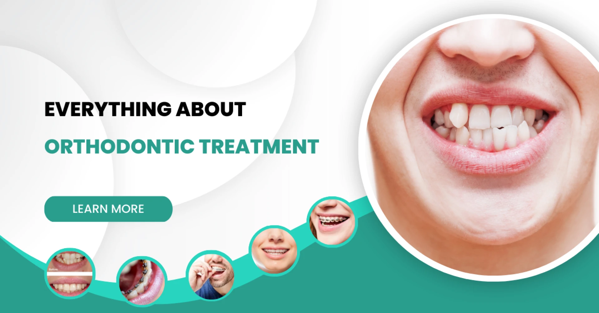 Everything About Orthodontic Treatment
