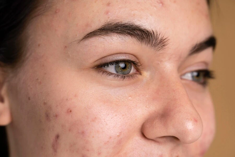The Ultimate Guide To Using Triluma Cream For Hyperpigmentation