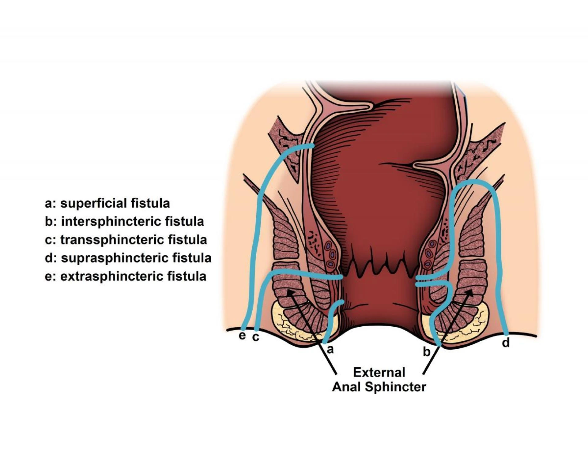 Exploring the Best Fistula Treatment in India: A Comprehensive Guide
