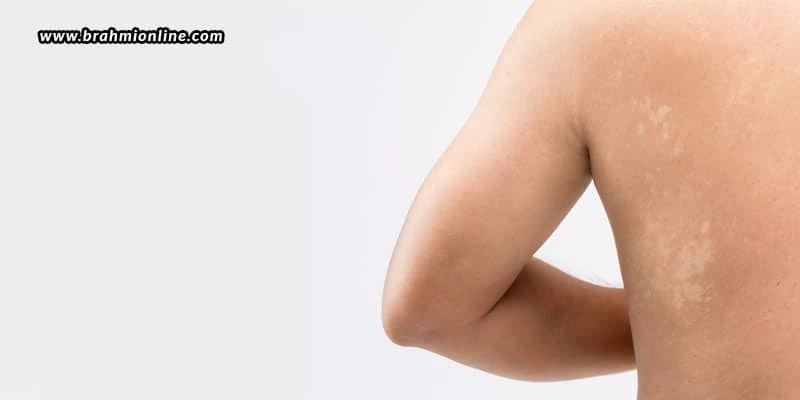Are You Suffering From Tinea Versicolor?