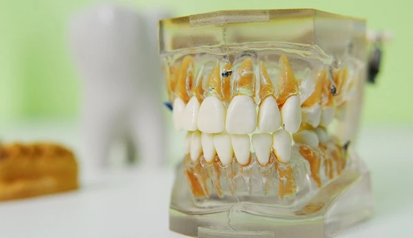 Things to Know Before Getting Dental Implant Treatment