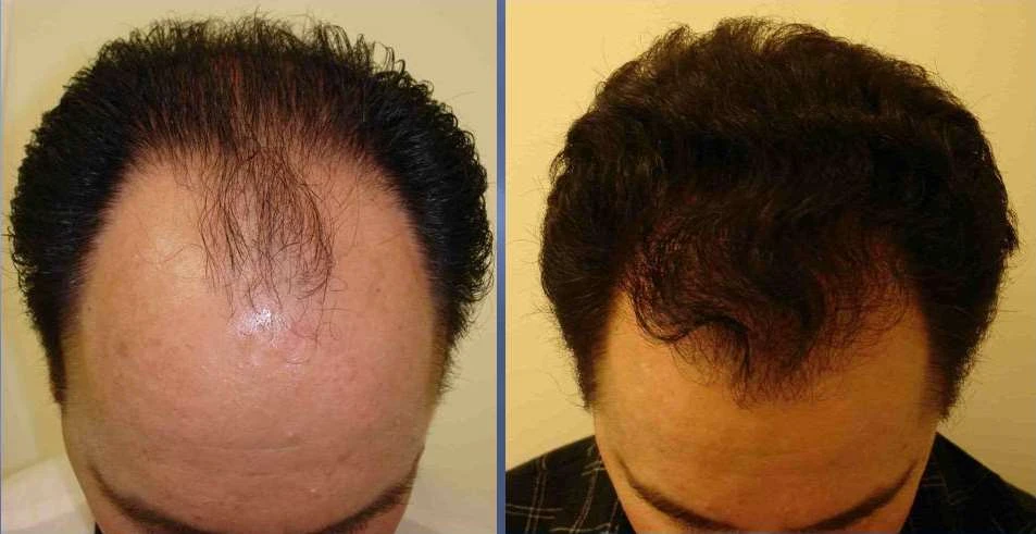 Choosing the Right Hair Transplant Option
