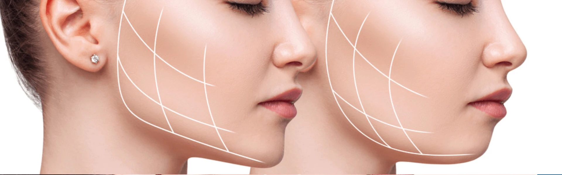 How Much Does Cost of Dimple Creation in India?