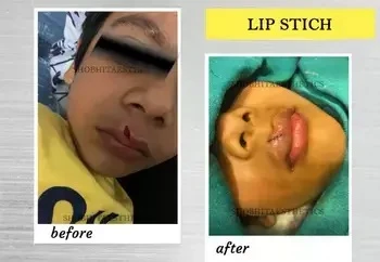 Know More about Lip Reduction Surgery cost in Delhi