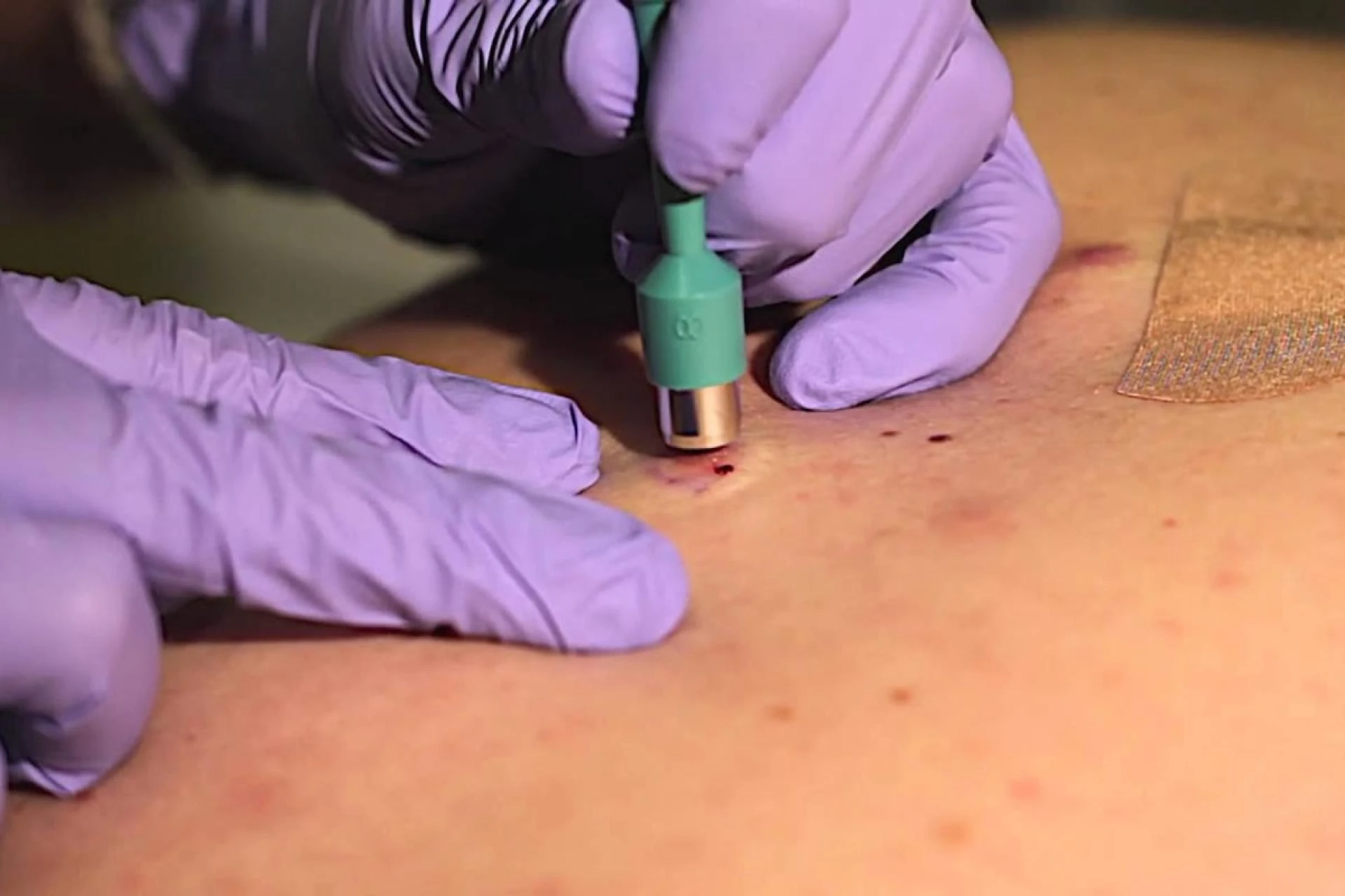 Technological Advancements and Innovations in Dermatology Boost the Skin Biopsy Industry