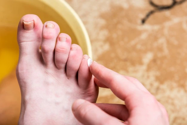 HOW DOES A PODIATRIST TREAT AN INGROWN TOENAIL?