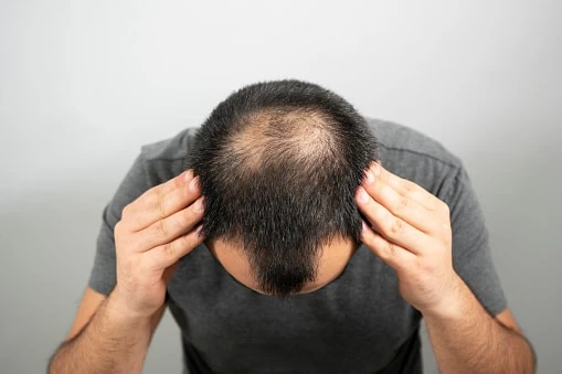 Which Treatment Is The Best Hair Regrowth Treatment?