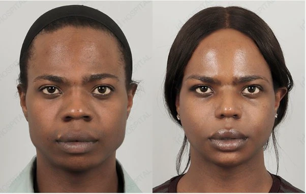 Facial feminization surgery in Delhi | Dr. Saroj K. Sheoran