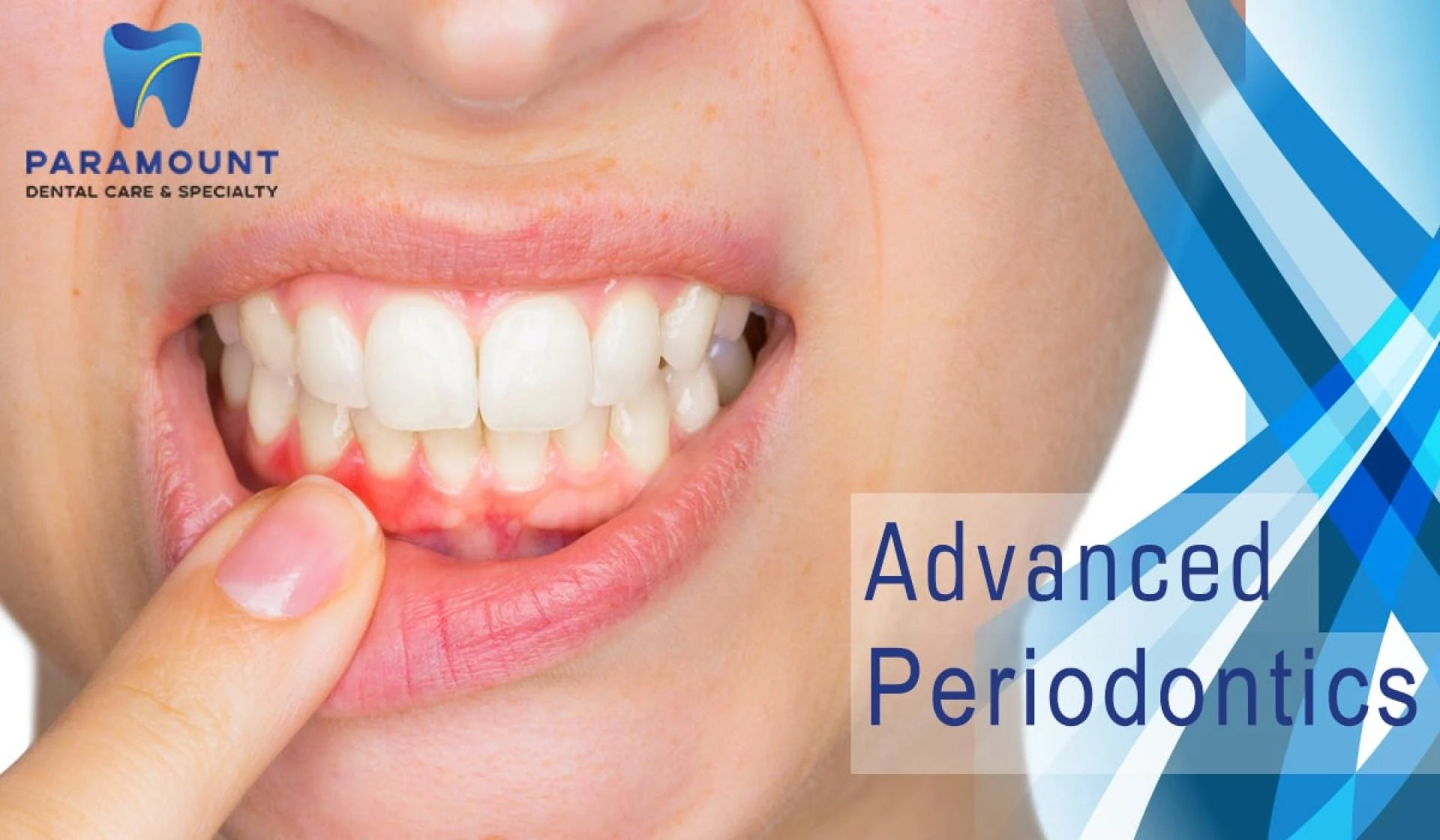 Three Benefits You Can Get By Advanced Periodontics Treatment