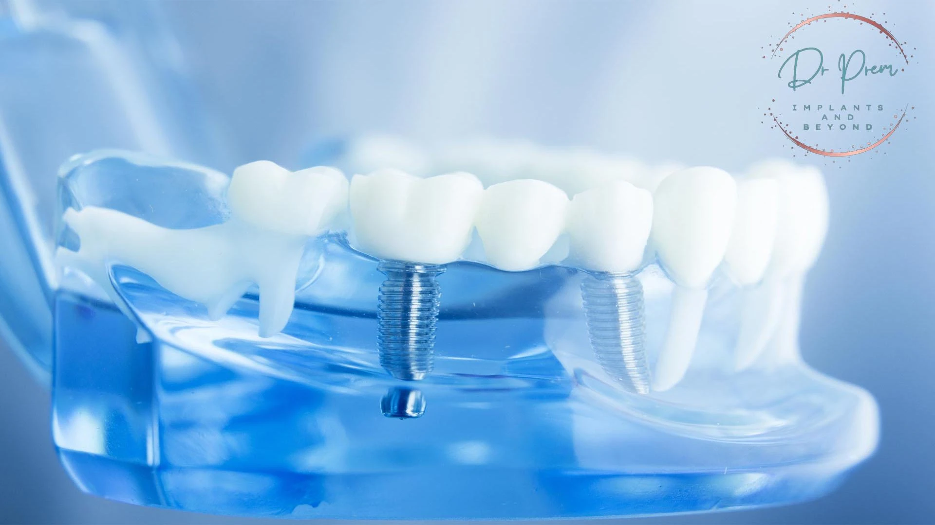 Single Teeth Implants vs. Traditional Bridges: A Timeless Decision
