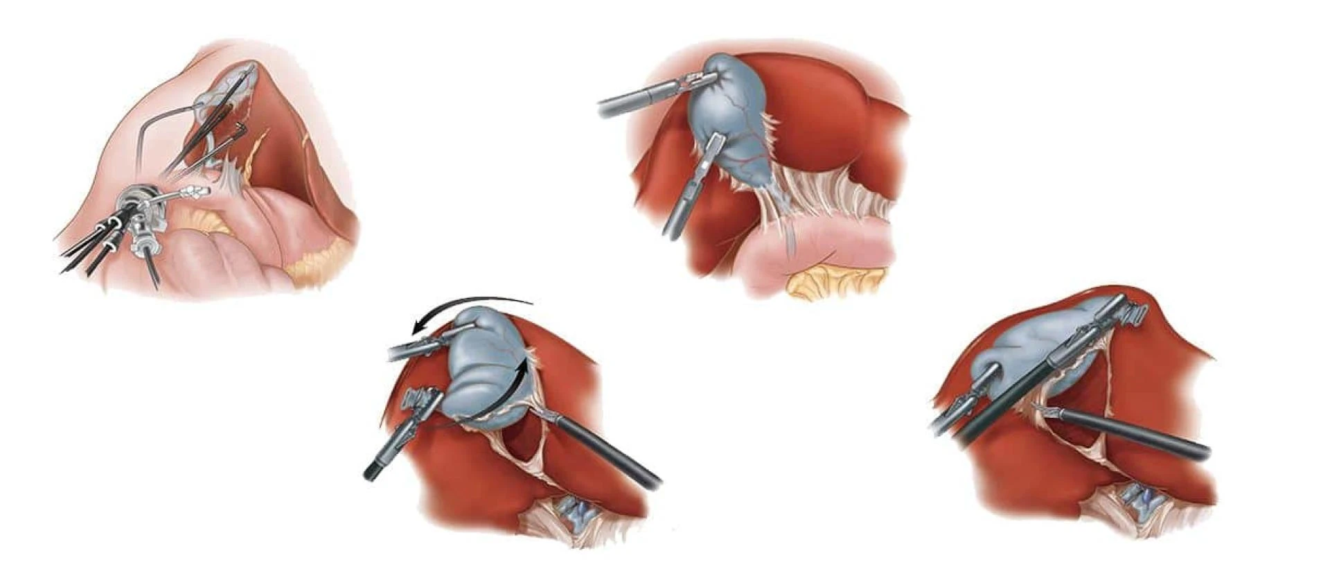 Laparoscopic Cholecystectomy &amp; Gallbladder removal in Pakistan