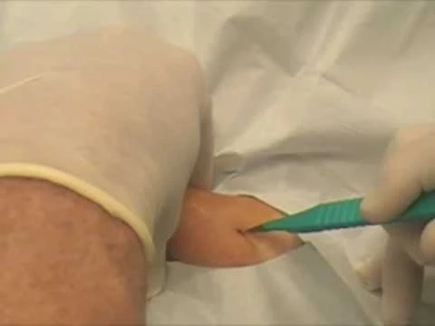 What is a bioidentical implant?