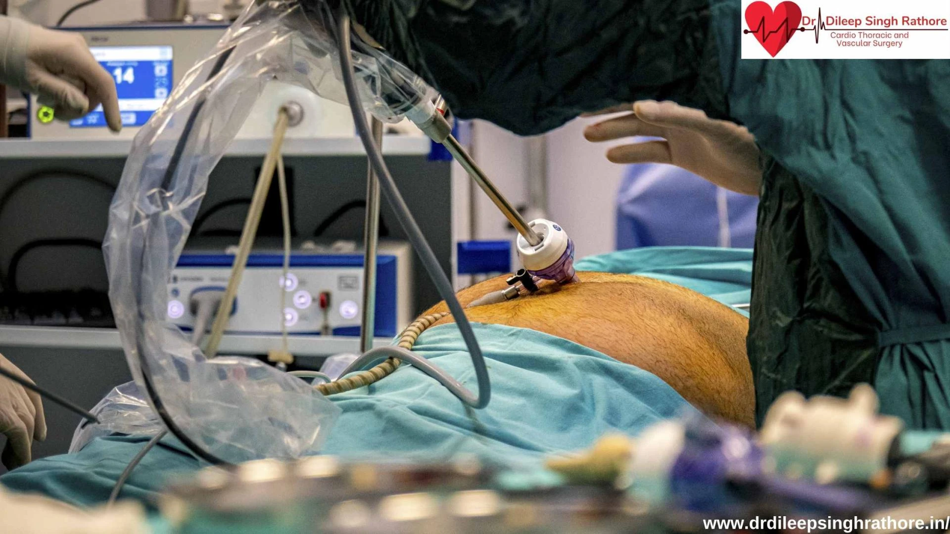 Top Bypass Surgeon In Bhopal: Your Ultimate Guide To Heart Health