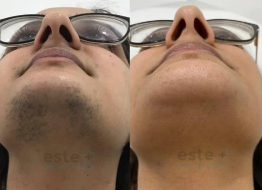 The procedure for the laser hair removal in a nutshell