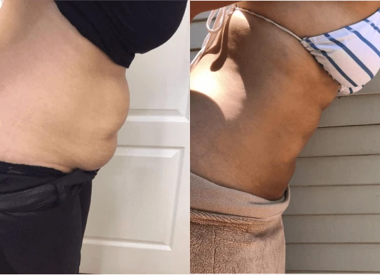 The science of cryolipolysis (freezing fat)