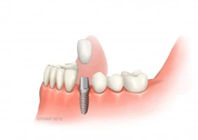 What to Expect During and After Successful Dental Implant Surgery