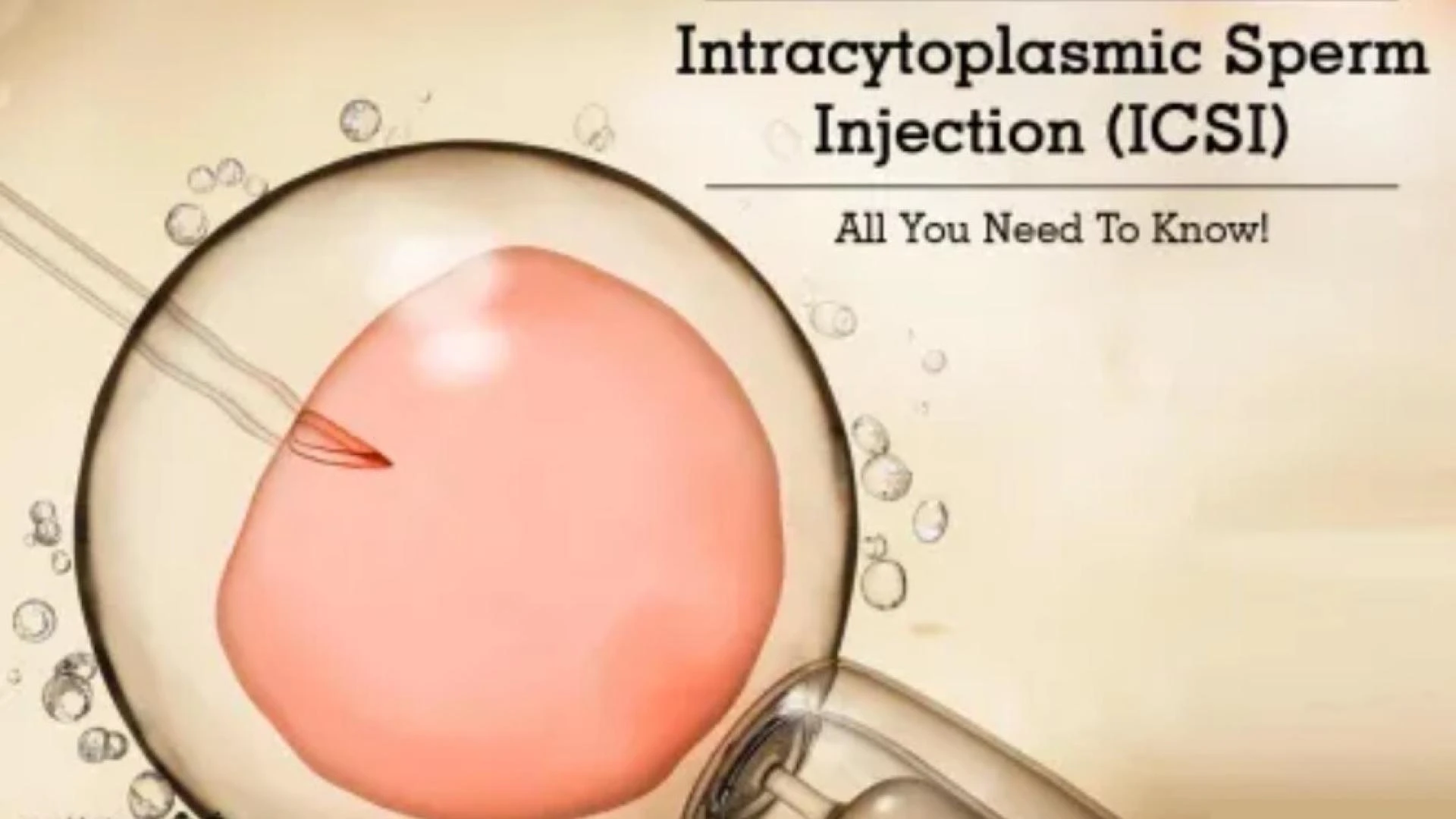 INTRACYTOPLASMIC SPERM INJECTION