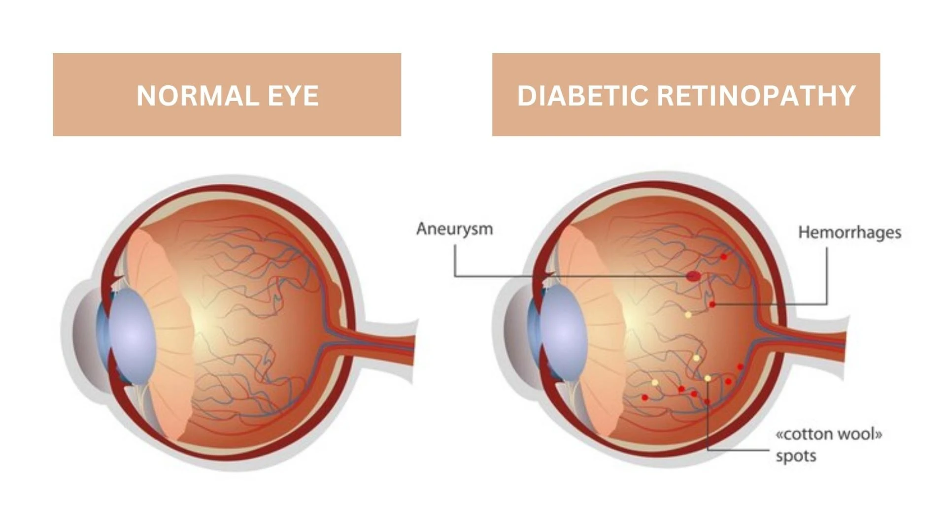 How to cure diabetic retinopathy?