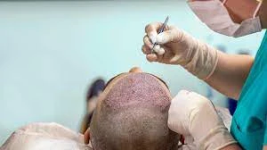 Hair Transplant In Delhi