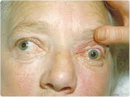 Best Glaucoma Treatment In Delhi