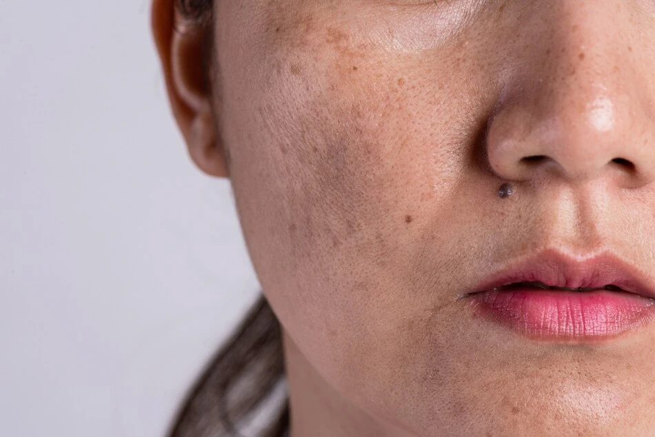 5 Common Reasons for Pigmentation on Face