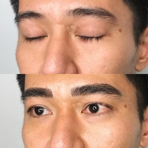 Eyebrow Transplant: A Long-Term Fix For Thin Eyebrows