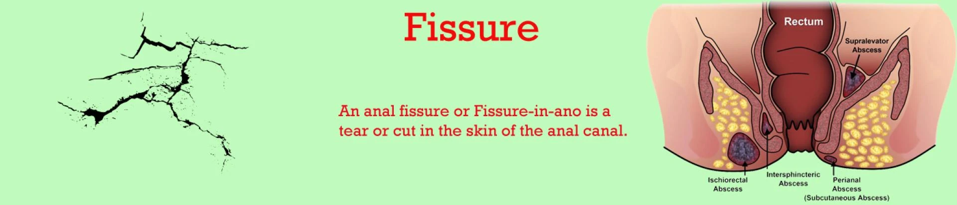 How to Pick the right Prologist for treating Anal Fissures?