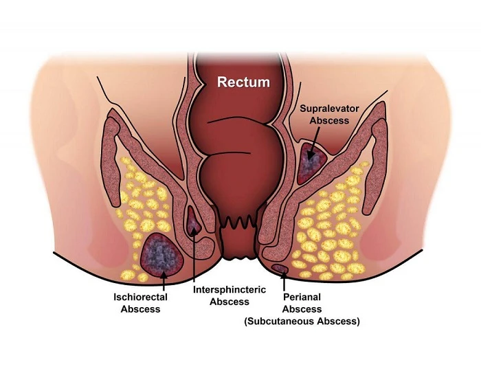 Anal Fistula Surgery: Understanding the Procedure and Recovery