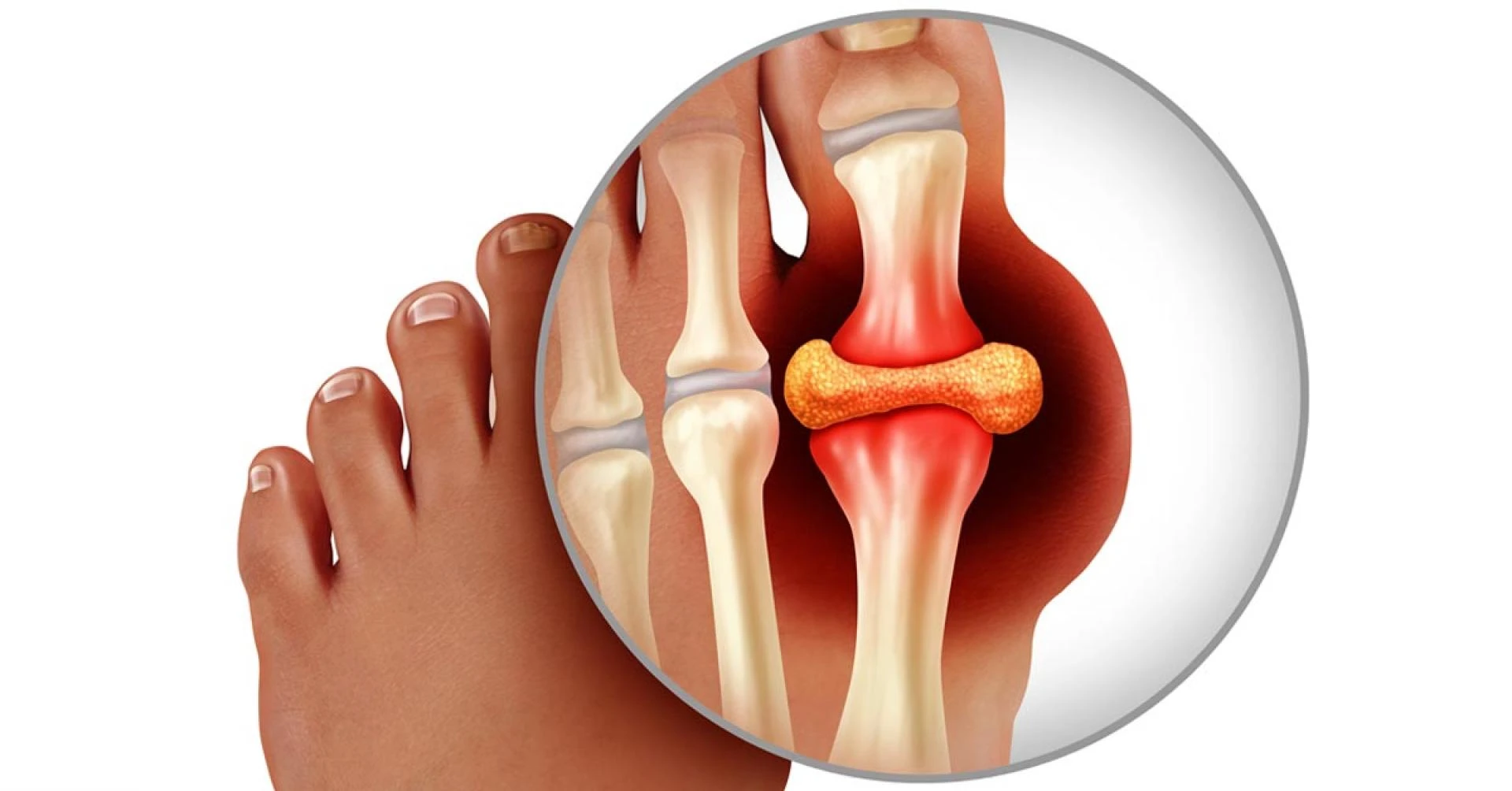 Gouty Arthritis Caused By Crystals Of Uric Acid Causes Intense Pain In The Joints