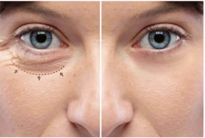What age is good for eyelid surgery?