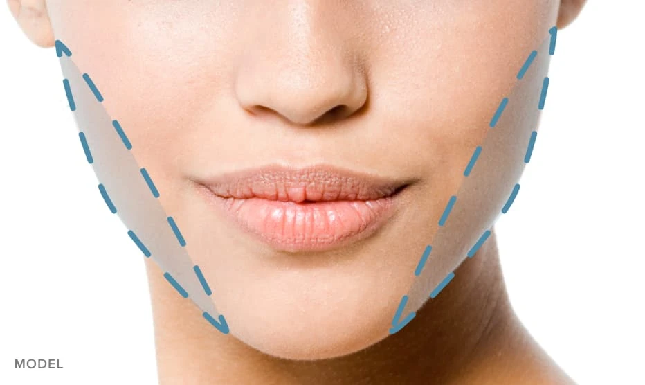 Buccal Pad Fat Removal Procedure | Dr. Rajat Gupta