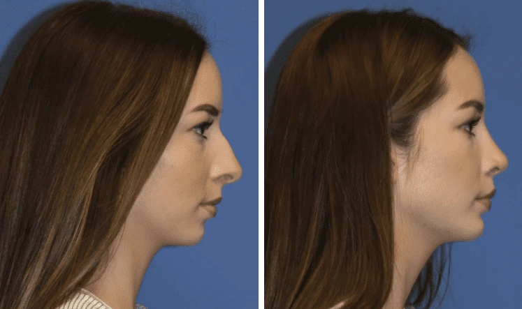 Chin Augmentation Procedure | Dr. Rajat Gupta