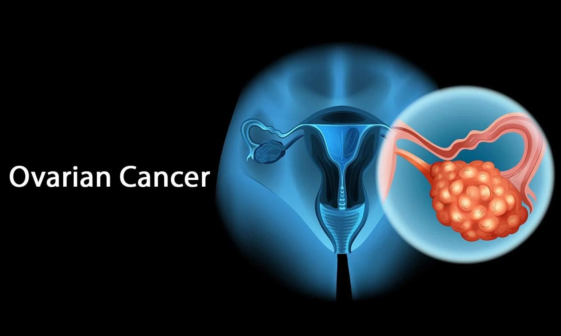 Ovarian Cancer Drugs Market Overview, Insights, Forecast Analysis during 2022-2028