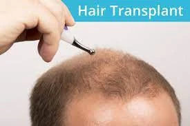 How Hair Loss Affects Self-Esteem