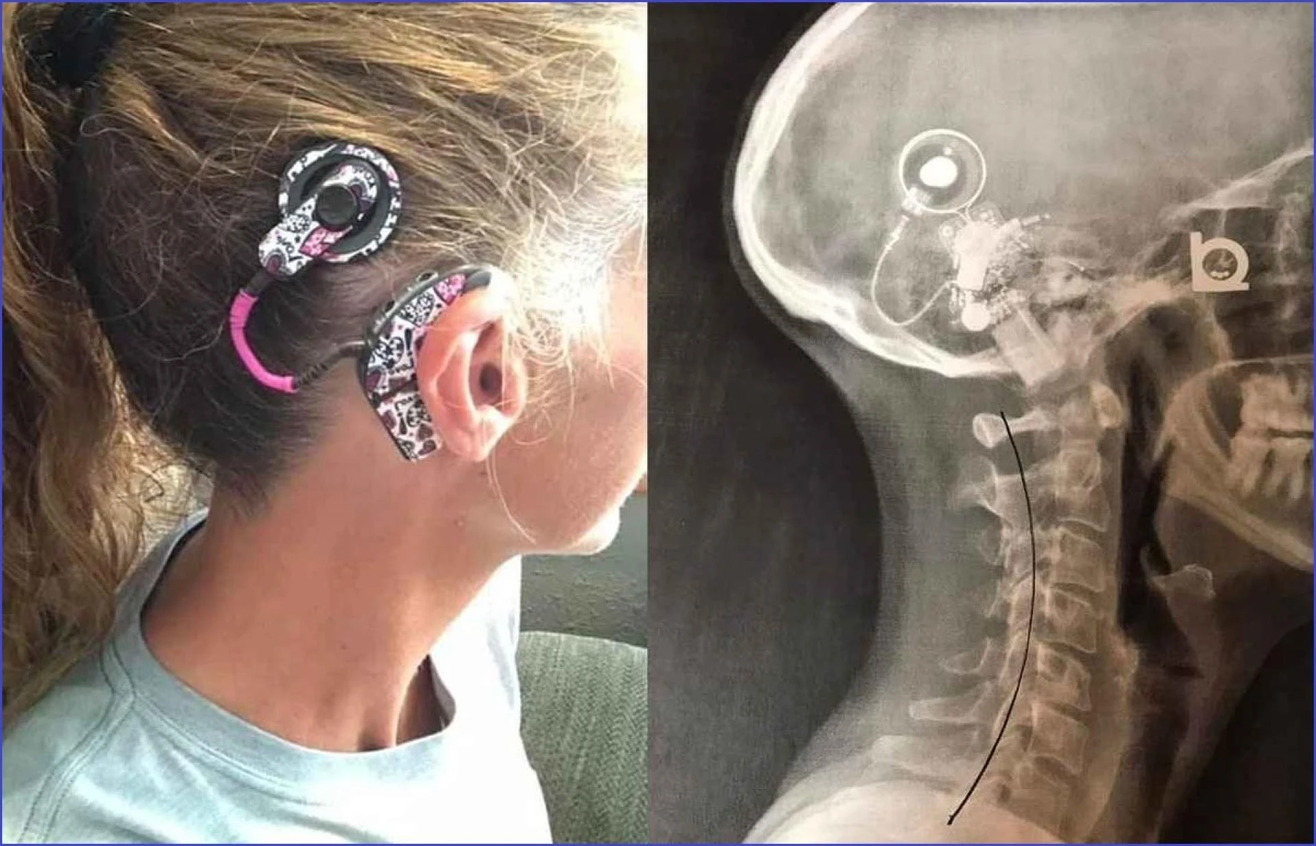 Advances in Hearing Solution by Best Cochlear Implant Surgeons of India