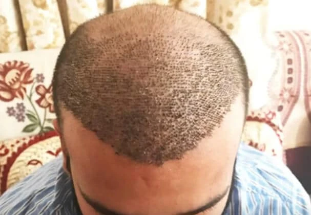 HAIR PLUGS Vs HAIR TRANSPLANT