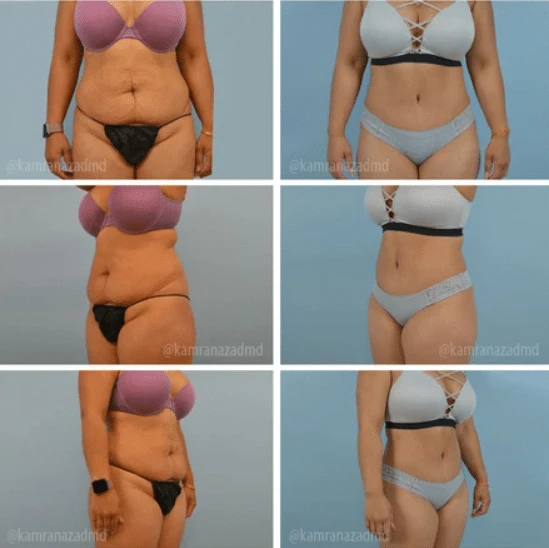 liposuction Orlando