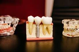 Dental implants