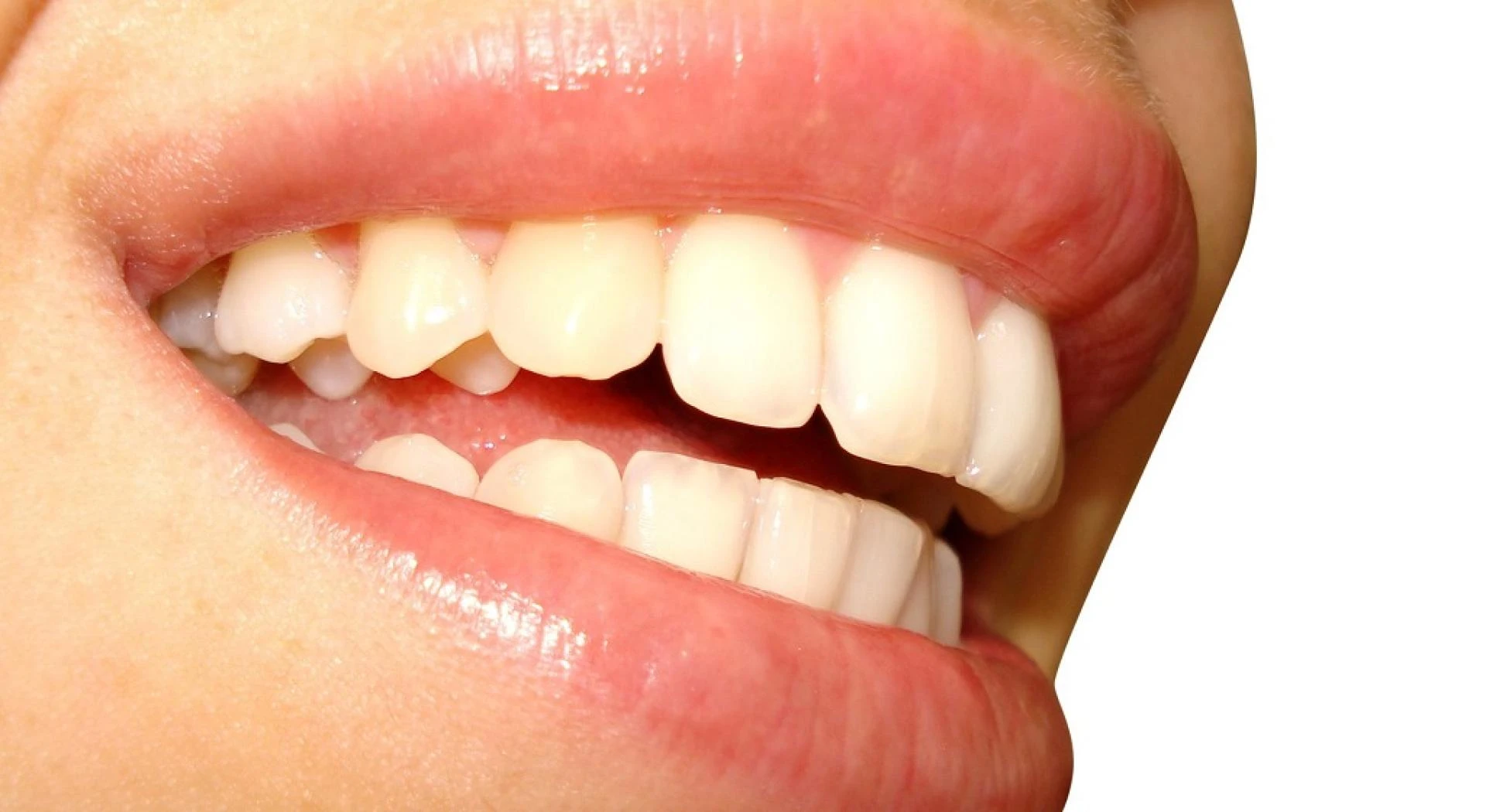 Teeth Whitening In London: Transform Your Smile In One Session