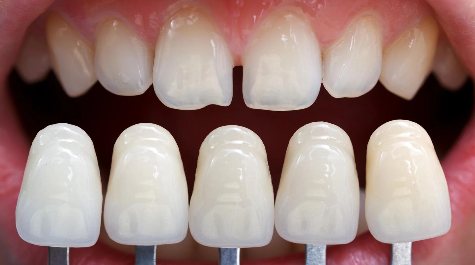 Veneers In London, Ontario: An Overview Of Treatment, Facts And Benefits