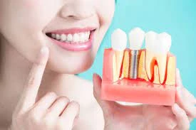 The Benefits of Having Dental Implant Services