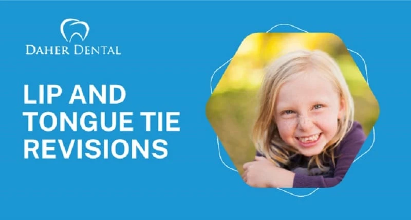 Laser Lip And Tongue Tie Revisions For Newborns | My London Dentist
